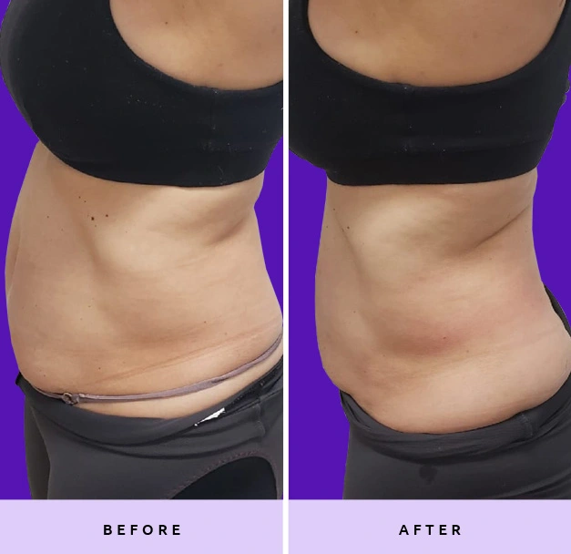 Before and After Fat Removal Banner