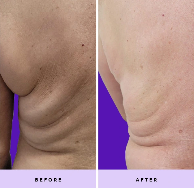 Before and After Fat Removal Banner